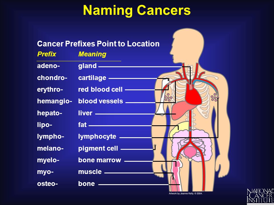 Cancer de huesos nombre